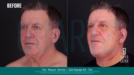 Before and after facelift and eyelid surgery results at Quartz Hospital, 8 days post-procedure