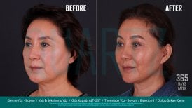 Before and after facelift and neck lift results at Quartz Hospital, visible facial rejuvenation