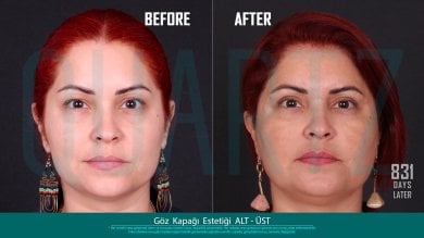 Before and after eyelid surgery results at Quartz Hospital, upper and lower blepharoplasty