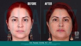 Before and after eyelid surgery results at Quartz Hospital, upper and lower blepharoplasty