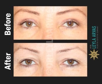 Before and after eyelid surgery results at Quartz Hospital – rejuvenated eye area appearance
