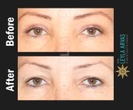Before and after eyelid surgery results at Quartz Hospital – rejuvenated eye area appearance
