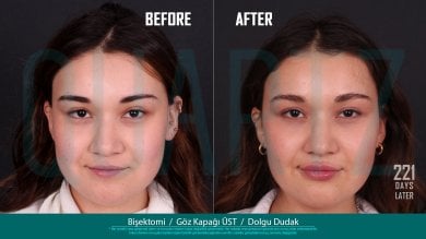 Before and after results of buccal fat removal, eyelid surgery, and lip filler at Quartz Hospital