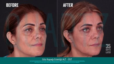 Before and after eyelid surgery results at Quartz Hospital, improved eye area appearance