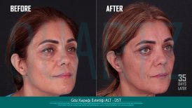 Before and after eyelid surgery results at Quartz Hospital, improved eye area appearance