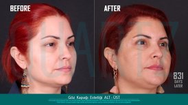 Before and after upper and lower eyelid surgery results at Quartz Hospital, rejuvenated look