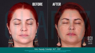 Before and after eyelid surgery results at Quartz Hospital – upper and lower blepharoplasty