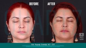Before and after eyelid surgery results at Quartz Hospital – upper and lower blepharoplasty