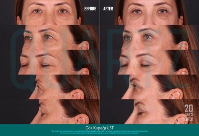Before and after upper eyelid surgery results at Quartz Hospital, 20 days post-procedure