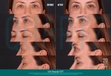 Before and after upper eyelid surgery results at Quartz Hospital, 20 days post-procedure