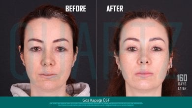 Before and after upper eyelid surgery results at Quartz Hospital, 160 days post-procedure