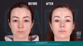 Before and after upper eyelid surgery results at Quartz Hospital, 160 days post-procedure