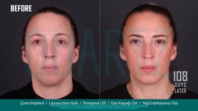 Deep plane facelift before and after results at Quartz Hospital, visible facial rejuvenation