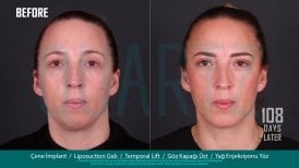Deep plane facelift before and after results at Quartz Hospital, visible facial rejuvenation