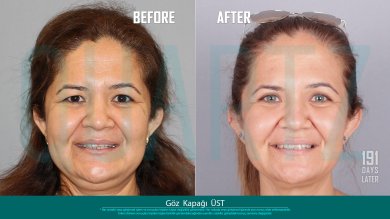 Before and after upper eyelid surgery results at Quartz Hospital – refreshed eye appearance