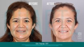 Before and after upper eyelid surgery results at Quartz Hospital – refreshed eye appearance
