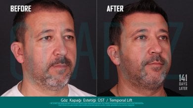 Before and after upper eyelid and temporal lift results at Quartz Hospital, rejuvenated appearance