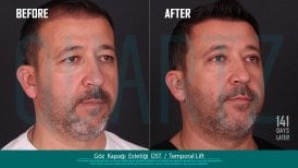 Before and after upper eyelid and temporal lift results at Quartz Hospital, rejuvenated appearance