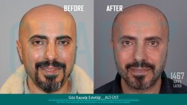 Before and after eyelid surgery results at Quartz Hospital, improved eye area appearance