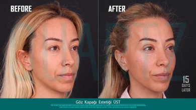 Before and after upper eyelid surgery results at Quartz Hospital, 15 days post-procedure