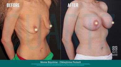 Before and after breast augmentation with implants at Quartz Hospital, visible enhancement result