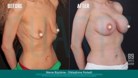 Before and after breast augmentation with implants at Quartz Hospital, visible enhancement result