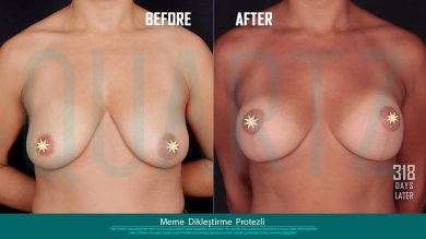 Before and after breast lift with implants results at Quartz Hospital, improved breast shape