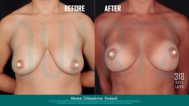 Before and after breast lift with implants results at Quartz Hospital, improved breast shape