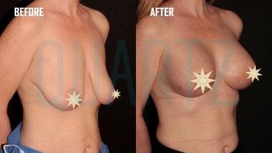Before and after breast lift and augmentation results at Quartz Hospital, improved breast shape