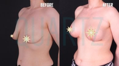 Before and after breast lift results at Quartz Hospital – visible breast contour improvement