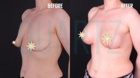 Before and after breast lift results at Quartz Hospital – visible breast contour improvement