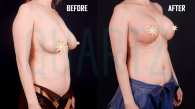 Before and after breast lift results at Quartz Hospital – visible breast contour improvement