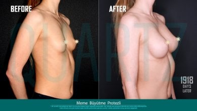 Before and after breast implants with lift at Quartz Hospital – enhanced breast contour result