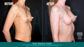 Before and after breast implants with lift at Quartz Hospital – enhanced breast contour result