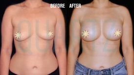 Before and after breast implants with lift at Quartz Hospital – enhanced breast shape result