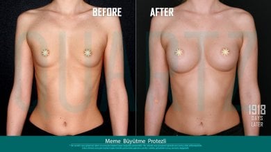 Before and after breast implants with lift at Quartz Hospital – enhanced breast shape result