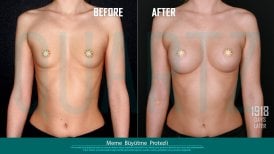 Before and after breast implants with lift at Quartz Hospital – enhanced breast shape result