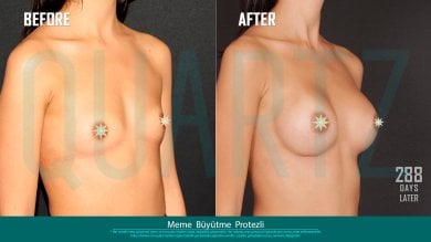 Before and after breast implants with lift at Quartz Hospital – enhanced breast contour result