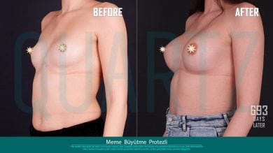 Before and after breast implants with lift at Quartz Hospital – enhanced breast contour result