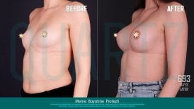 Before and after breast implants with lift at Quartz Hospital – enhanced breast contour result