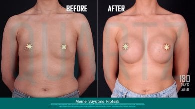 Before and after breast implants with lift at Quartz Hospital – enhanced breast shape result