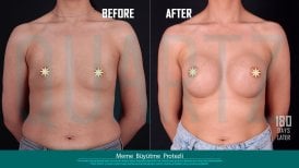 Before and after breast implants with lift at Quartz Hospital – enhanced breast shape result