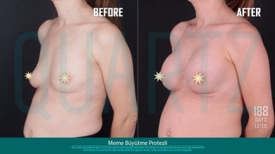Before and after breast implants with lift at Quartz Hospital – visible enhancement results