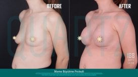 Before and after breast implants with lift at Quartz Hospital – visible enhancement results