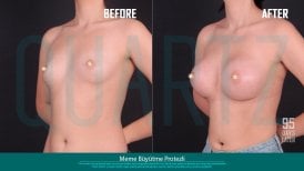 Before and after breast implants with lift at Quartz Hospital – enhanced breast shape result