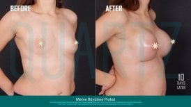 Before and after breast implants with lift at Quartz Hospital – enhanced breast shape result