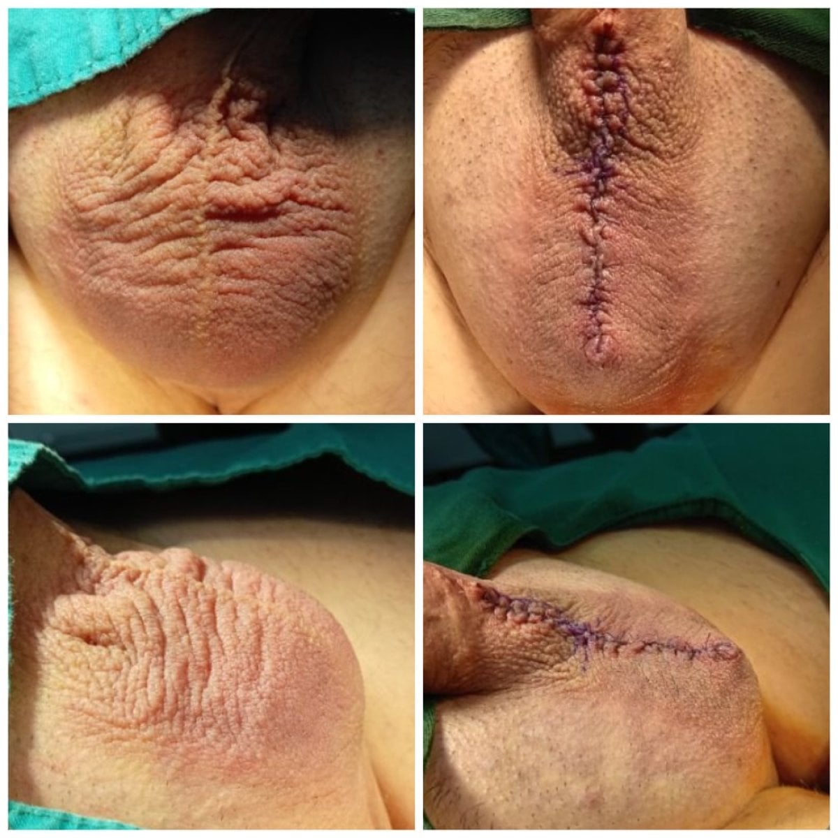 Resultados antes y después de escrotoplastia en Menness Wellness Clinic, mejora estética