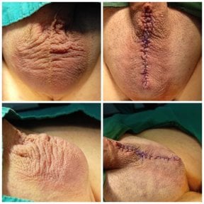 Before and after scrotoplasty results at Menness Wellness Clinic, improved scrotal appearance