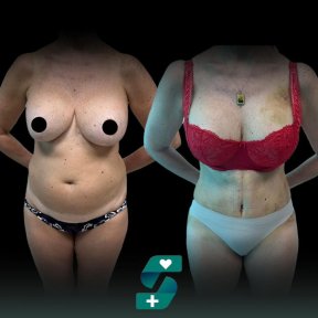Résultats avant/après liposuccion chez Soraca Med – amélioration visible de la silhouette