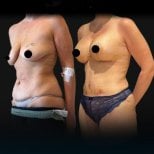 Résultats avant et après liposuccion chez Soraca Med – silhouette et abdomen améliorés